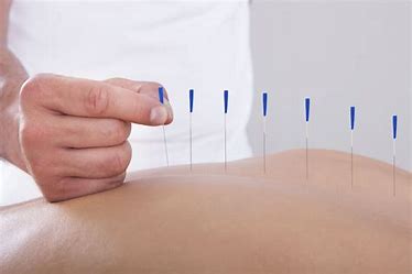 Benefits of Acupuncture in Physiotherapy