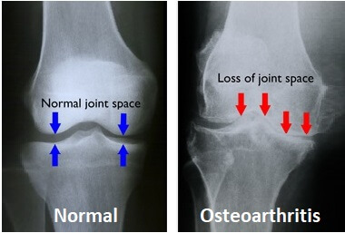 X-Ray showing OA knee  that causes Severe knee joint pain 